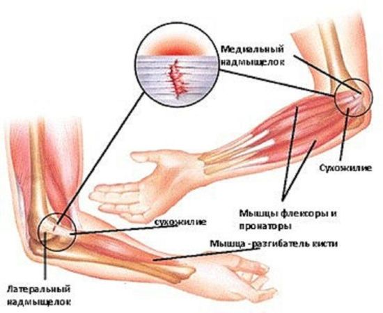 Эпикондилит