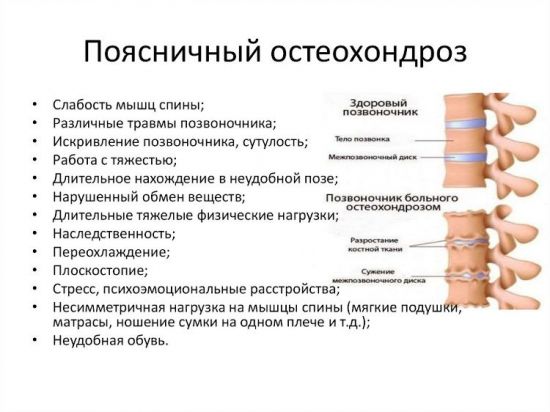 Признаки поясничного остеохондроза